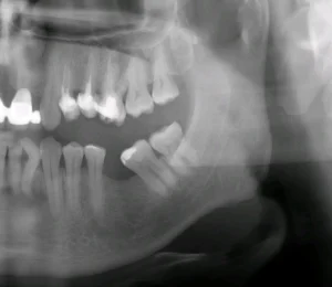 Immediate Tooth Extraction and Implant Placement – Faster, Predictable, and Aesthetic Tooth Replacement tandimplantat Malmö